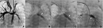 Systematic approach to obtain axillary arterial access for pediatric heart catheterizations